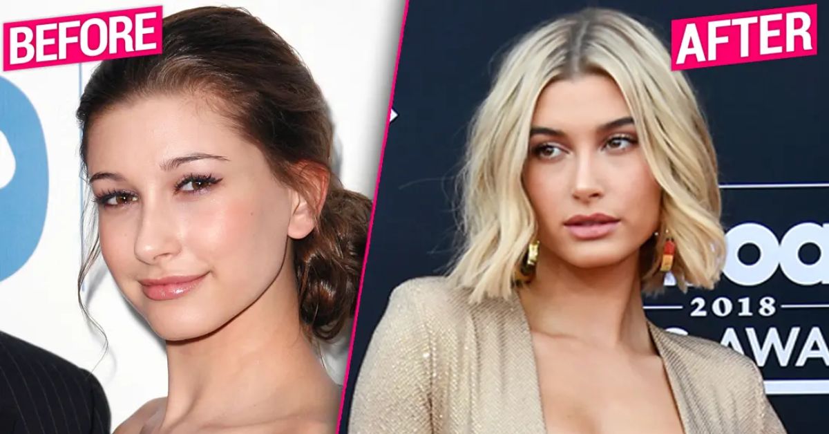 Hailey Baldwin Plastic Surgery: Lip Filling