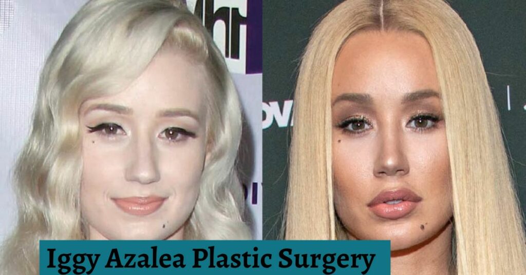 Iggy Azalea Plastic Surgery